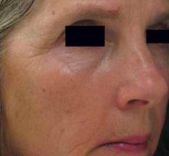 Fine Lines & Wrinkles After Treatment